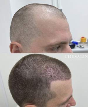 Результат трансплантации волос в височно-лобную зону: фото до и через 6 дней после пересадки. Работа Ивана Павловича Чесалина