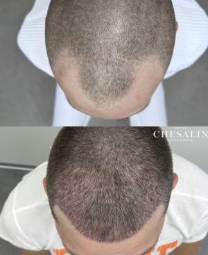 Результат трансплантации волос в височно-лобную зону: фото до и через 6 дней после пересадки. Работа Ивана Павловича Чесалина
