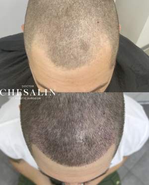 Результат трансплантации волос в височно-лобную зону: фото до и 6 дней после пересадки. Работа Ивана Павловича Чесалина