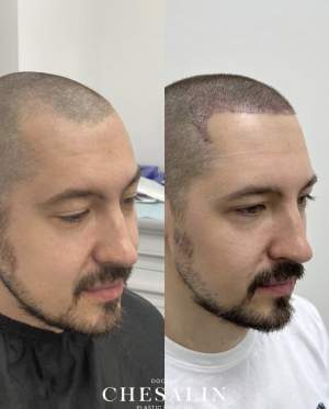 Результат трансплантации волос в височно-лобную зону: фото до и 6 дней после пересадки. Работа Ивана Павловича Чесалина
