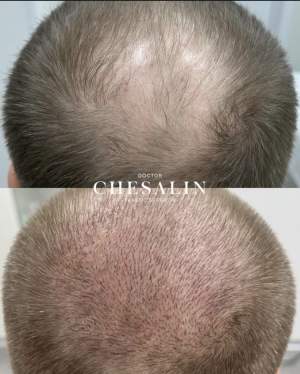 Результат трансплантации волос на 10-е сутки: фото до и на плановом осмотре. Работа Ивана Павловича Чесалина