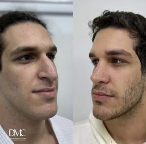 Год спустя после ринопластики: фото до и после