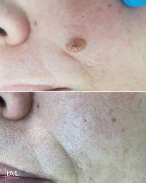 Фото до и после лазерного удаления новообразования над верхней губой