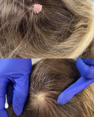 Лазерное удаление новообразования на волосистой части головы