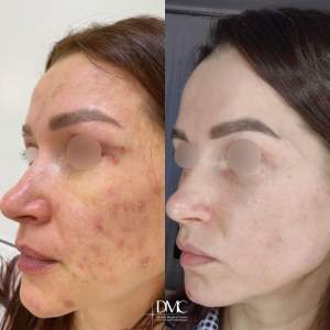 Промежуточный результат лечения кожи, в который был включён и метод лазерной шлифовки лица