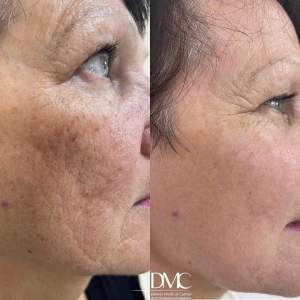Результат лазерной шлифовки кожи лица - фото до и после полной реабилитации