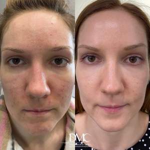 Результат лечения кожи методом лазерной шлифовки - фото до и после реабилитации