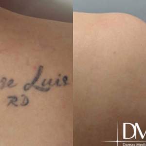 Лазерное удаление татуировки на руке_ фото до и после
