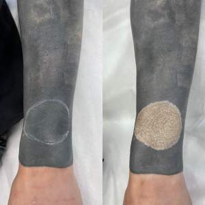 Лазерное удаление татуировки - фото до и после