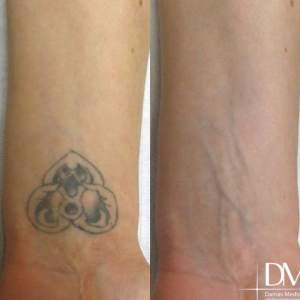 Результат лазерного удаления татуировки - фото до и после