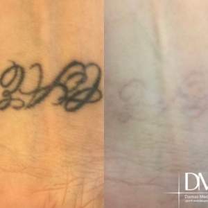 Фото до и после лазерного удаления татуировки