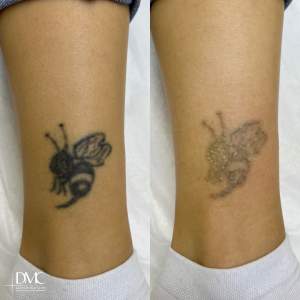 Фото до и сразу после лазерного удаления татуировки на ноге