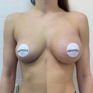 Увеличение объема и формы груди анатомическими имплантами (до и после).