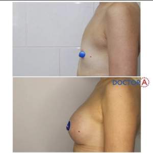 Увеличение груди (до и после первичной реабилитации).