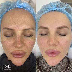 Фото до и после комплексного лечения, лазерного удаления осудив и лечения пигментации на лице.