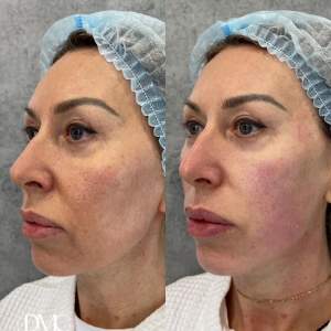 Безоперационная ультразвуковая подтяжка лица и шеи - фото до после процедуры