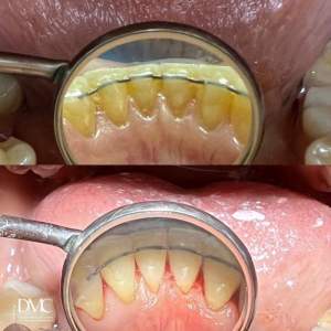 Гигиеническая комплексная чистка зубов с установленным ретейнером (до и после).