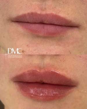 Коррекция формы и объема губ: до и сразу после процедуры