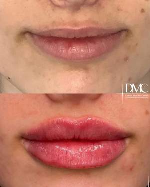 Коррекция формы и объема губ: до и сразу после процедуры