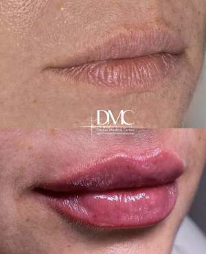 Результат после процедуры коррекции формы и объёма губ: фото до и после процедуры