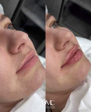 Результат коррекции формы и объёма губ: фото до и после