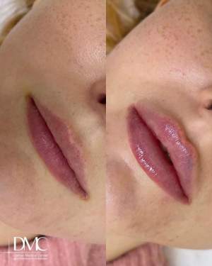 Фото до и после процедуры коррекции формы и объёма губ