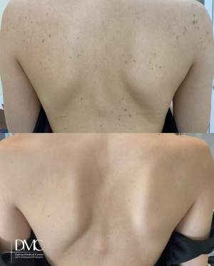 Лечение угревой болезни спины: фото до и после