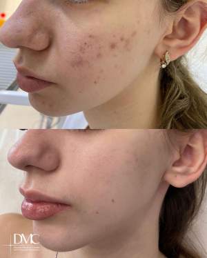 Результат промежуточного лечения высыпаний кожи: до и на плановом осмотре