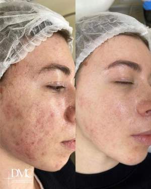 Промежуточный этап лечения воспалений кожи