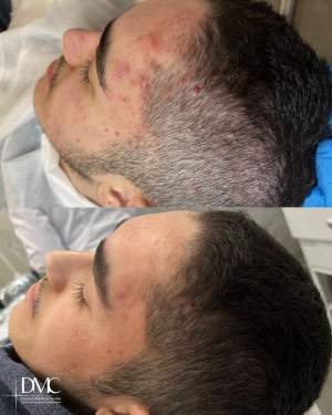Промежуточный этап лечения высыпаний кожи: фото до и через 2 недели