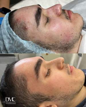 Промежуточный этап лечения высыпаний кожи: фото до и через 2 недели