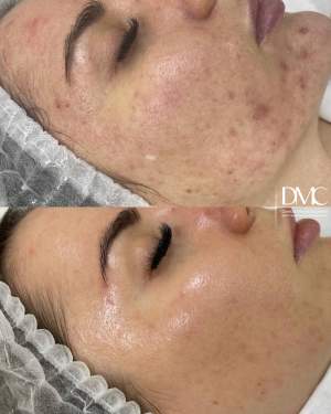 Промежуточный этап лечения кожи лица