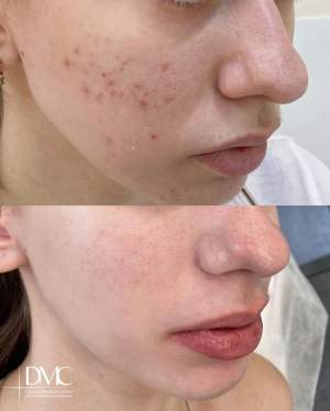 Результат промежуточного лечения высыпаний кожи: до и на плановом осмотре