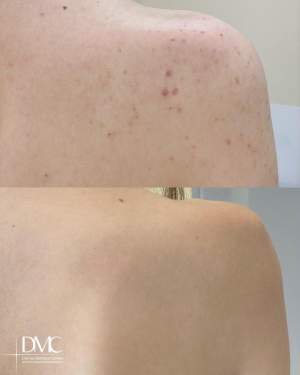 Лечение угревой болезни спины: фото до и после
