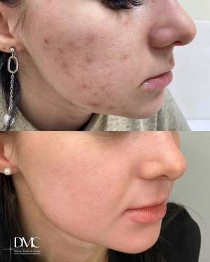 Промежуточный результат лечения высыпаний кожи: фото до и после на плановом осмотре