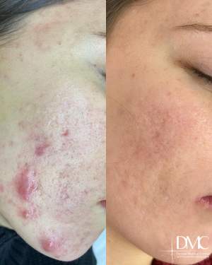 Промежуточный результат лечения высыпаний кожи: фото до и на плановом осмотре