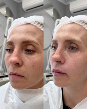 Результат коррекции носогубных складок и формы губ: фото до и после