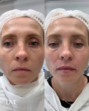 Результат коррекции носогубных складок и формы губ: фото до и после