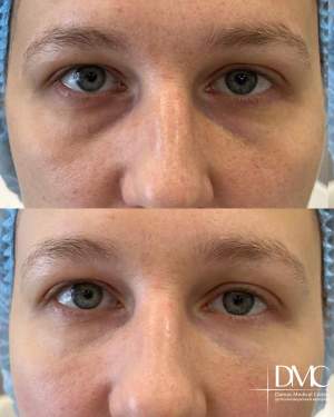 Коррекция носослезной борозды: фото до и после