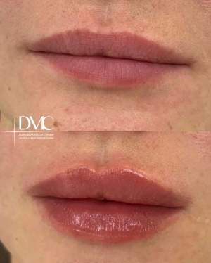 Результат коррекции формы и объёма губ: фото до и после