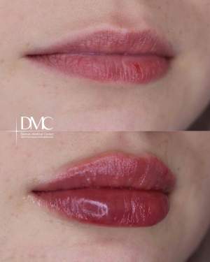 Фото до и после  процедуры коррекции формы и объёма губ