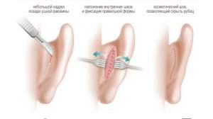 При коррекции лопоухости хирургический доступ формируется в кожных складках на задней поверхности уха.