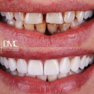 Реставрация режущего края зубов с коррекцией диастемы методом установки виниров.