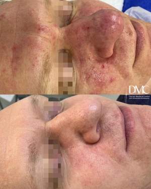 Результат лечения кожи вылечили Розацеа: фото до и после