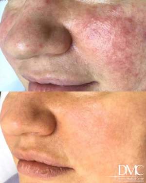 Результат лазерного удаления сосудов на лице: фото до и после