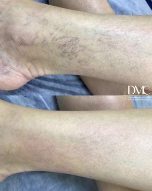 Результат лазерного удаления сосудов на ноге: фото до и после