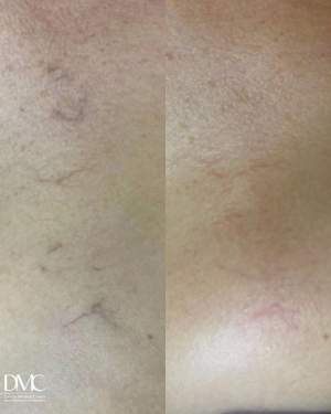 Лазерное удаление сосудов на груди: до и сразу после одного сеанса