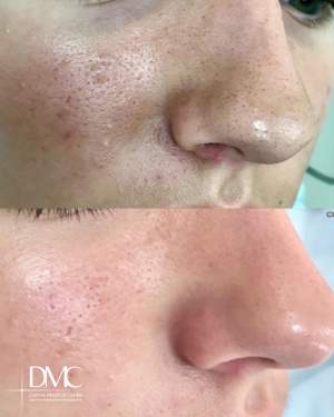 Вакуумная чистка лица: фото до и сразу после процедуры