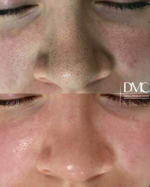 Вакуумная чистка лица: фото до и сразу после процедуры