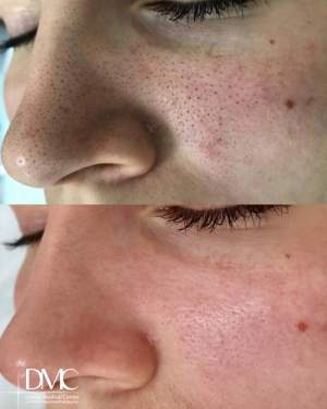 Результат вакуумного гидропилинга  Silk Peel на лице: фото до и после